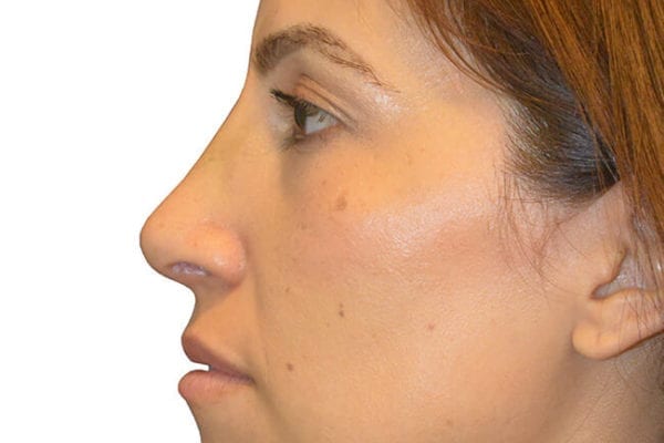 Rhinoplasty Patient 02 - After - 1 Carousel Thumbnail