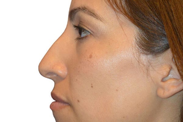 Rhinoplasty Patient 02 - Before - 1 Carousel Thumbnail