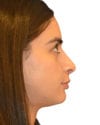 Rhinoplasty Patient 03 - After - 1 thumbnail