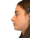 Rhinoplasty Patient 03 - After - 1 thumbnail