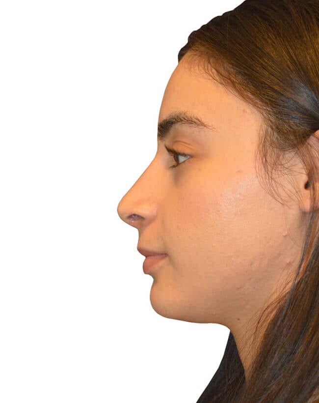 Rhinoplasty Patient 03 - After - 2