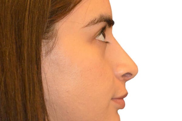 Rhinoplasty Patient 03 - After - 1 Carousel Thumbnail