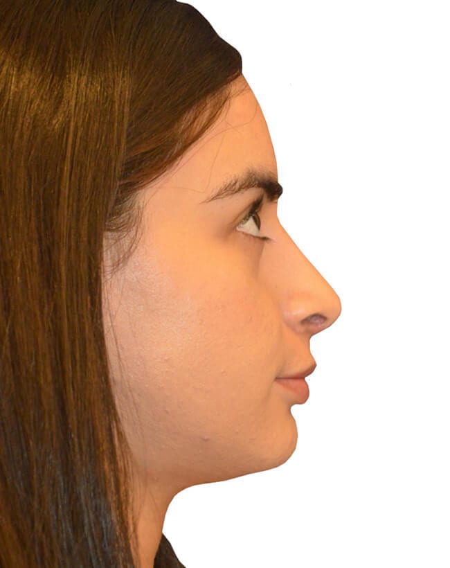 Rhinoplasty Patient 03 - After - 1