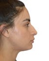 Rhinoplasty Patient 03 - Before - 1 thumbnail