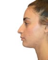 Rhinoplasty Patient 03 - Before - 1 thumbnail
