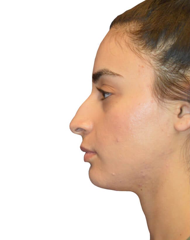 Rhinoplasty Patient 03 - Before - 2