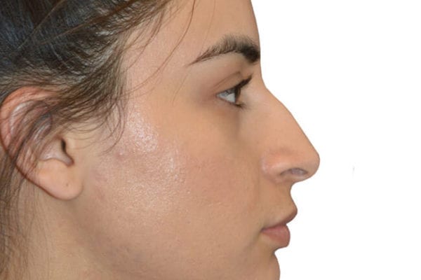 Rhinoplasty Patient 03 - Before - 1 Carousel Thumbnail