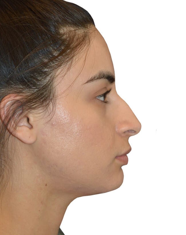 Rhinoplasty Patient 03 - Before - 1
