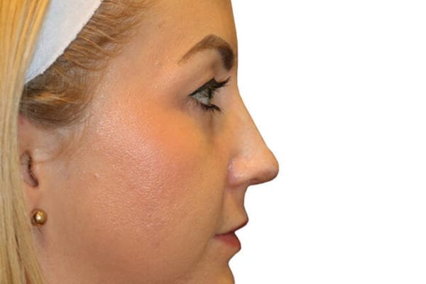 Rhinoplasty Patient 04 - After - 1 Carousel Thumbnail