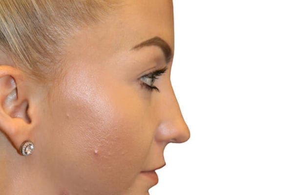 Rhinoplasty Patient 04 - Before - 1 Carousel Thumbnail