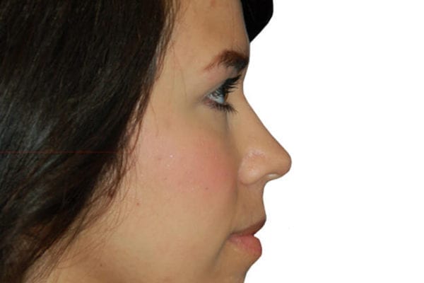 Rhinoplasty Patient 05 - After - 1 Carousel Thumbnail