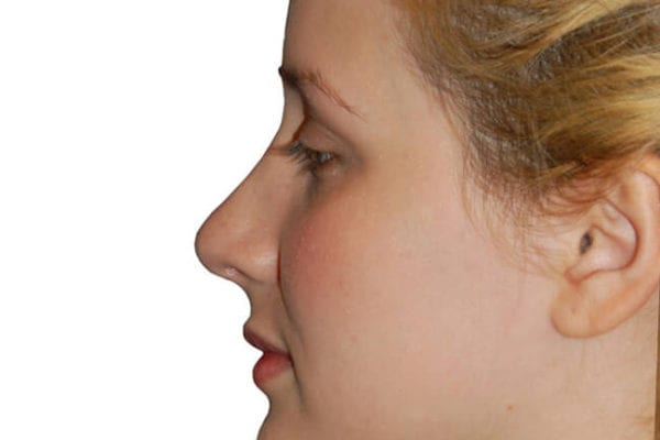 Rhinoplasty Patient 06 - After - 1 Carousel Thumbnail