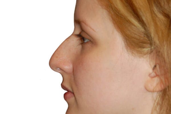Rhinoplasty Patient 06 - Before - 1 Carousel Thumbnail