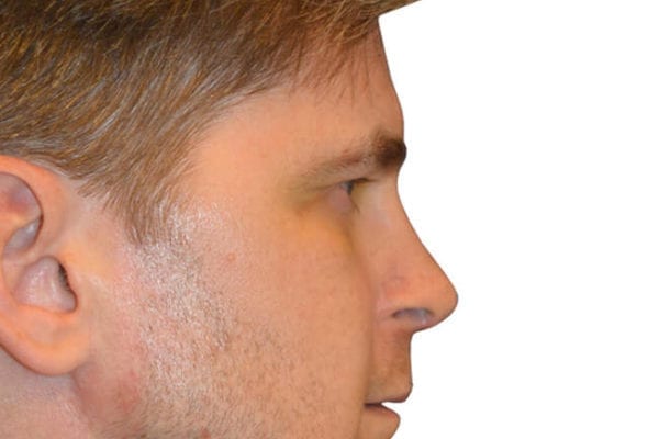 Rhinoplasty Patient 10 - After - 1 Carousel Thumbnail