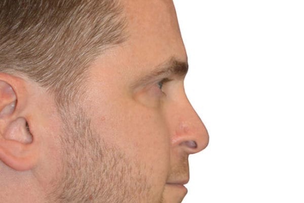 Rhinoplasty Patient 10 - Before - 1 Carousel Thumbnail