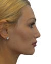 Rhinoplasty Patient 11 - After - 1 thumbnail