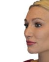 Rhinoplasty Patient 11 - After - 1 thumbnail