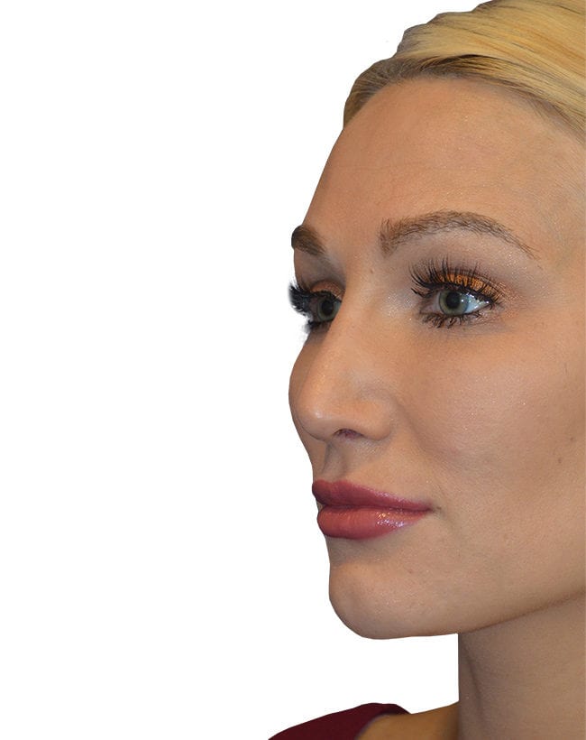 Rhinoplasty Patient 11 - After - 2