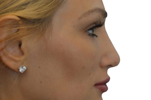 Rhinoplasty Patient 11 - After - 1 Carousel Thumbnail