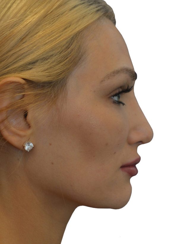 Rhinoplasty Patient 11 - Patient After 1