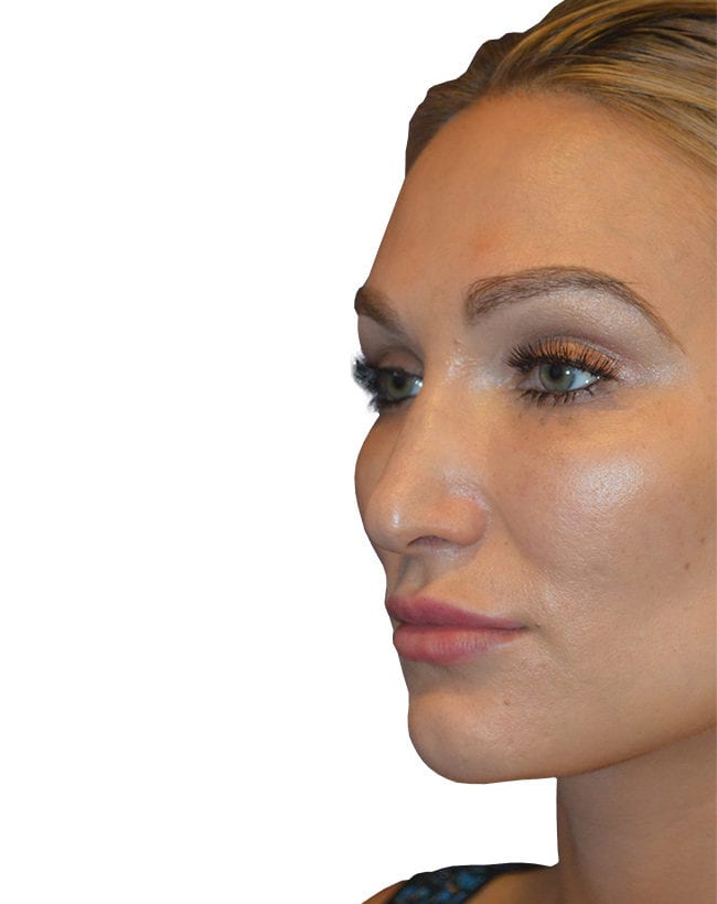 Rhinoplasty Patient 11 - Before - 2