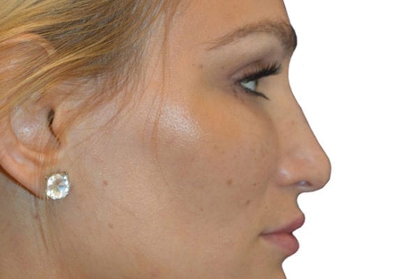 Rhinoplasty Patient 11 - Before - 1 Carousel Thumbnail