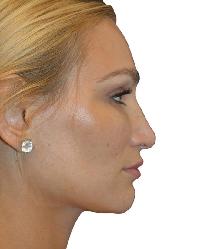Rhinoplasty Patient 11 - Patient Before 1