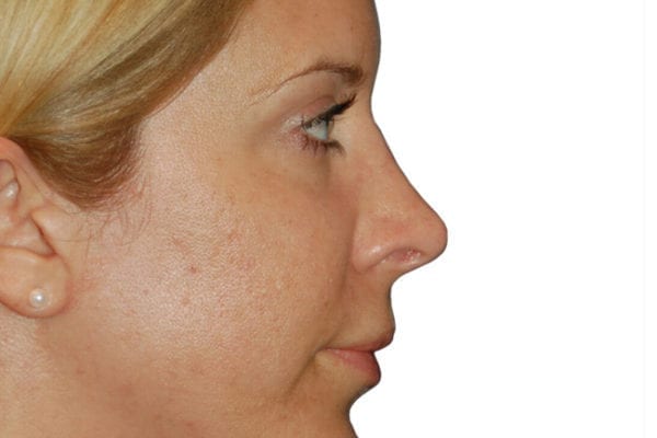 Rhinoplasty Patient 12 - After - 1 Carousel Thumbnail
