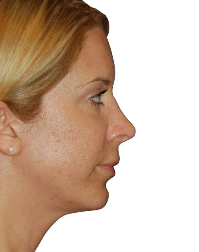 Rhinoplasty Patient 12 - After - 1