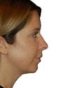 Rhinoplasty Patient 12 - Before - 1 thumbnail