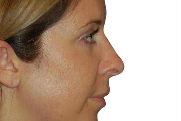 Rhinoplasty Patient 12 - Before - 1 Carousel Thumbnail