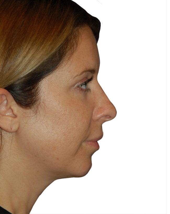 Rhinoplasty Patient 12 - Before - 1
