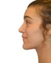 Rhinoplasty Patient 13 - After - 1 thumbnail