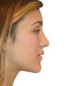 Rhinoplasty Patient 13 - After - 1 thumbnail