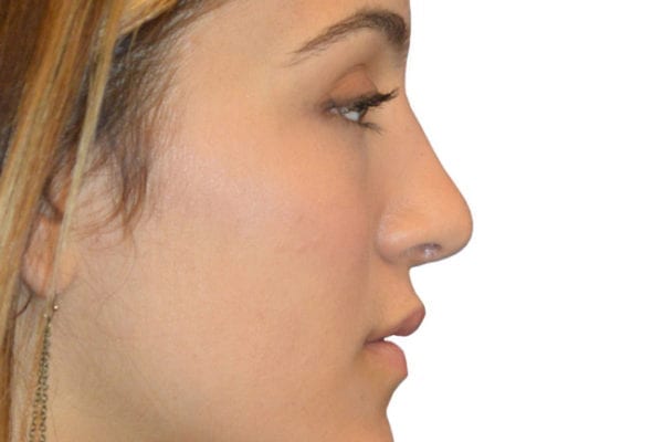 Rhinoplasty Patient 13 - After - 1 Carousel Thumbnail