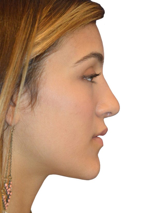 Rhinoplasty Patient 13 - After - 1