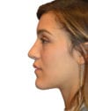 Rhinoplasty Patient 13 - After - 1 thumbnail