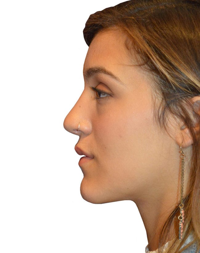 Rhinoplasty Patient 13 - After - 4