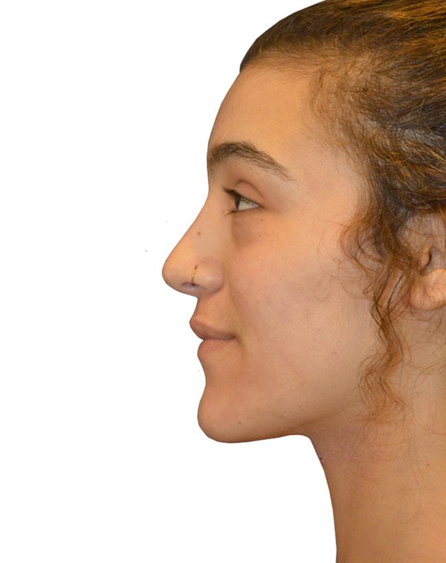 Rhinoplasty Patient 13 - After - 2