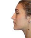 Rhinoplasty Patient 13 - Before - 1 thumbnail