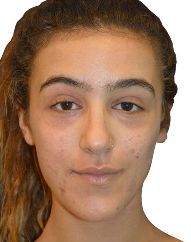 Rhinoplasty Patient 13 - Before - 3