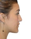 Rhinoplasty Patient 13 - Before - 1 thumbnail