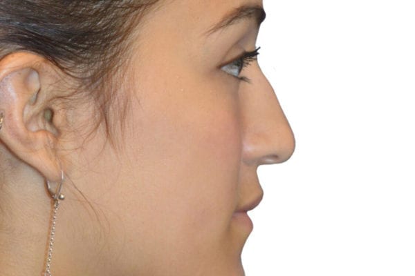 Rhinoplasty Patient 13 - Before - 1 Carousel Thumbnail