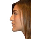 Rhinoplasty Patient 13 - Before - 1 thumbnail