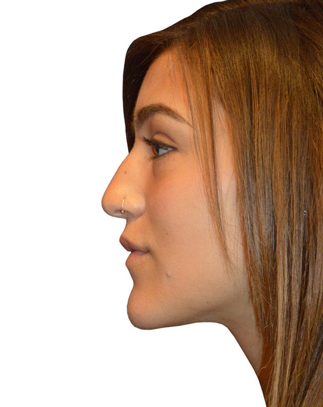 Rhinoplasty Patient 13 - Before - 4
