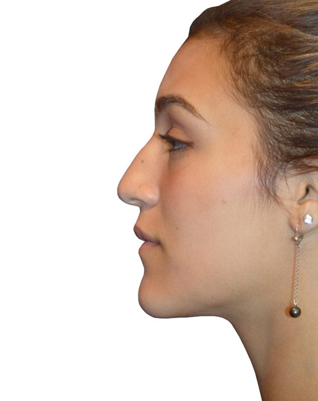Rhinoplasty Patient 13 - Before - 2