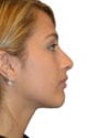 Rhinoplasty Patient 14 - After - 1 thumbnail