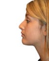 Rhinoplasty Patient 14 - Before - 1 thumbnail