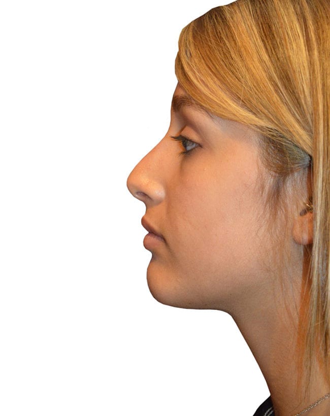 Rhinoplasty Patient 14 - Before - 2