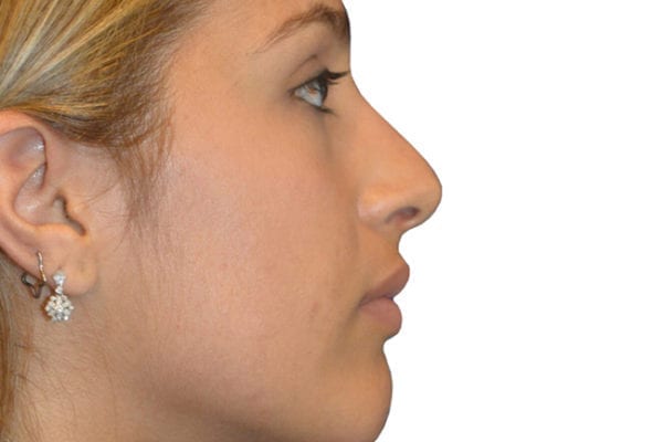 Rhinoplasty Patient 14 - After - 1 Carousel Thumbnail